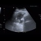 Abscess, Crohn's disease: US - Ultrasound